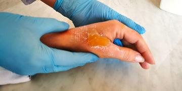 Second-Degree Burns: Symptoms, Causes & Treatment