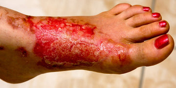 Third-Degree Burns: Causes, Symptoms & The Best Treatment