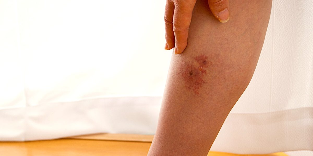 Cellulitis Common Causes, Symptoms, Prevention Tips, and The Best Treatment