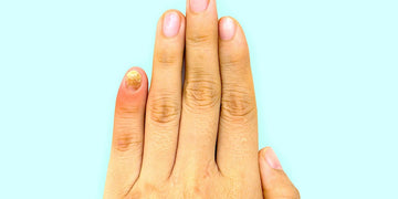 Fingernail Fungus: The Common Causes, Symptoms, Health Risks, and Best Treatment to Heal & Prevent Infections