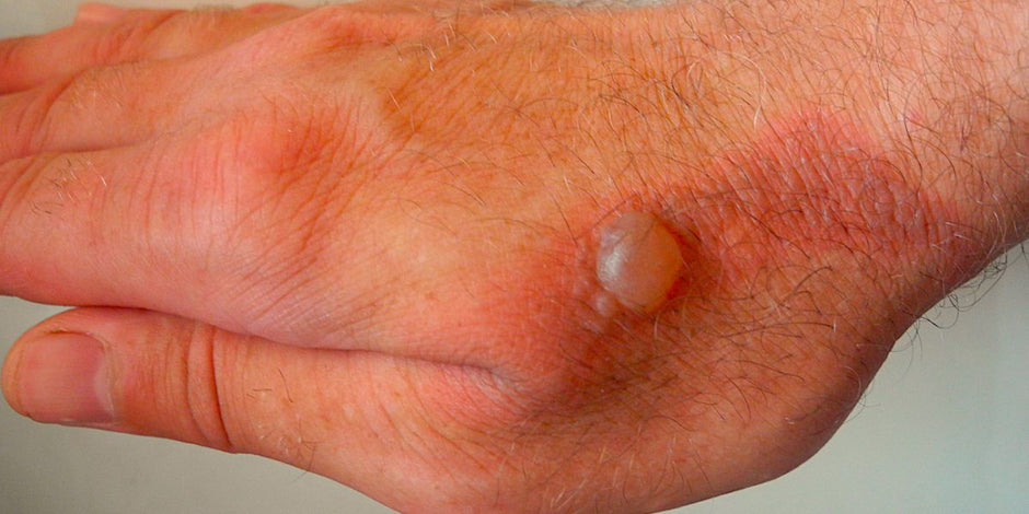 First Degree Burns Symptoms Causes And The Best Treatment