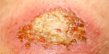 Infected Cuts: Learn How to Identify & Treat Them Fast to Prevent Complications