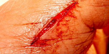 Skin Lacerations: Tips to Quickly Treat, Heal & Prevent Infection
