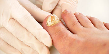 Toenail Fungus: The Common Causes, Symptoms, Health Risks, and The Best Treatment for Preventing Infection